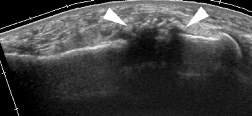 Ultrasound image of a metatarsal stress fracture showing cortical irregularity and periosteal reaction.