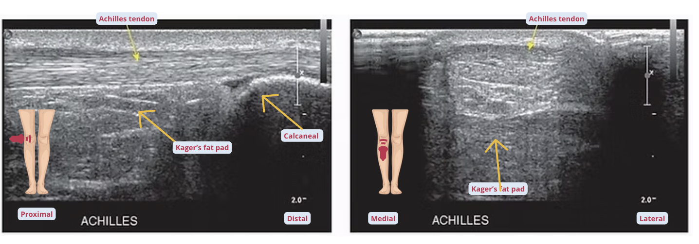 Side-by-side musculoskeletal ultrasound images of the Achilles tendon demonstrating longitudinal (long-axis) and transverse (short-axis) views for assessment of fiber continuity and cross-sectional morphology.