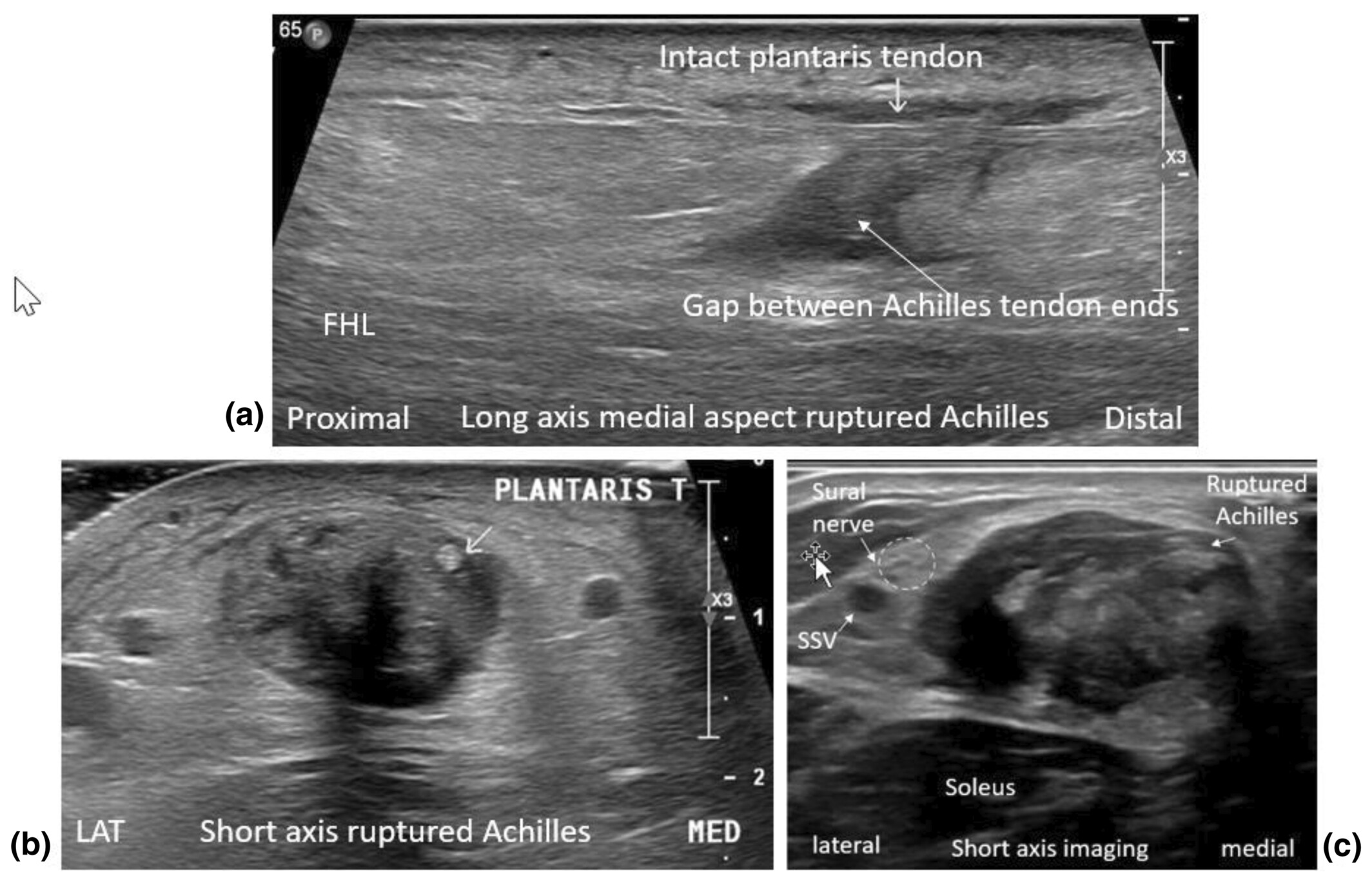 Long-axis and short-axis musculoskeletal ultrasound images demonstrating a complete Achilles tendon rupture. The long-axis image shows discontinuity of the Achilles tendon with a visible gap between tendon ends and an intact plantaris tendon. The short-axis images demonstrate tendon disruption, surrounding hematoma, and adjacent anatomical structures including the soleus muscle, sural nerve, and small saphenous vein.