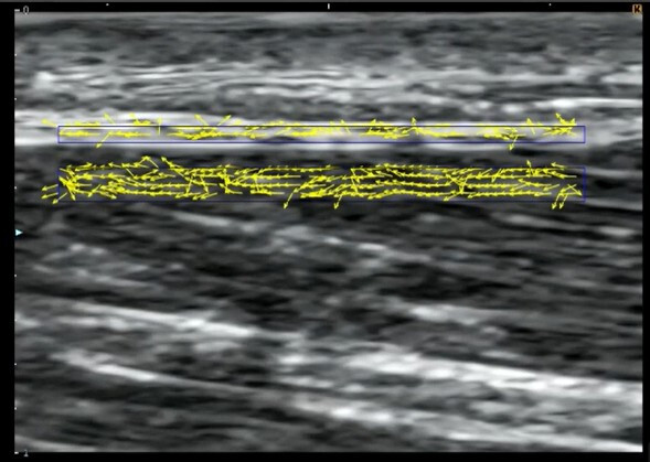 Ultrasound image of lower leg with motion tracking vectors showing fascial and muscle displacement for analysis of tissue gliding