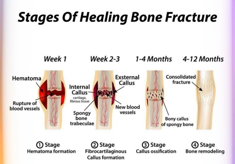 Illustration demonstrating the biological stages of fracture healing, including hematoma formation, fibrocartilaginous callus formation, callus ossification, and bone remodeling, progressing from the acute injury phase to complete fracture consolidation.