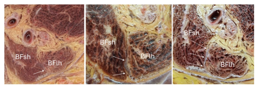 Axial cadaveric sections of the distal biceps femoris demonstrating the anatomical relationship between the long head (BFlh) and short head (BFsh), with arrows indicating the connective tissue interface forming the biceps femoris T-junction.