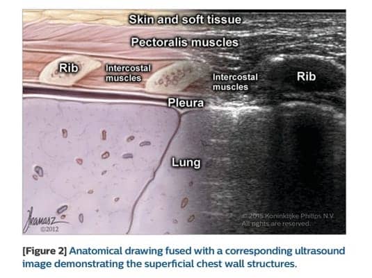 Educational diagram and ultrasound image showing chest wall anatomy including rib cortex, intercostal muscles, pleura, and lung interface.
