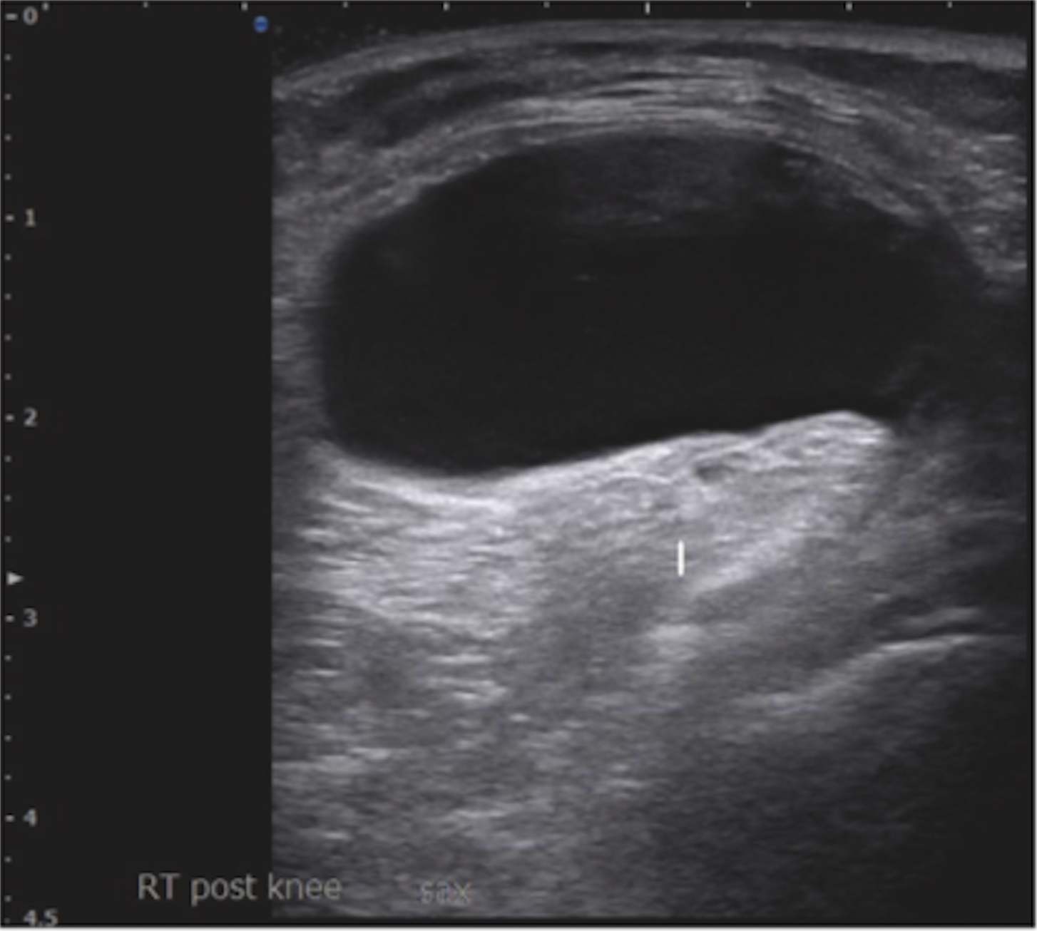 Posterior knee ultrasound showing a Baker’s cyst with increased acoustic brightness deep to the fluid collection.