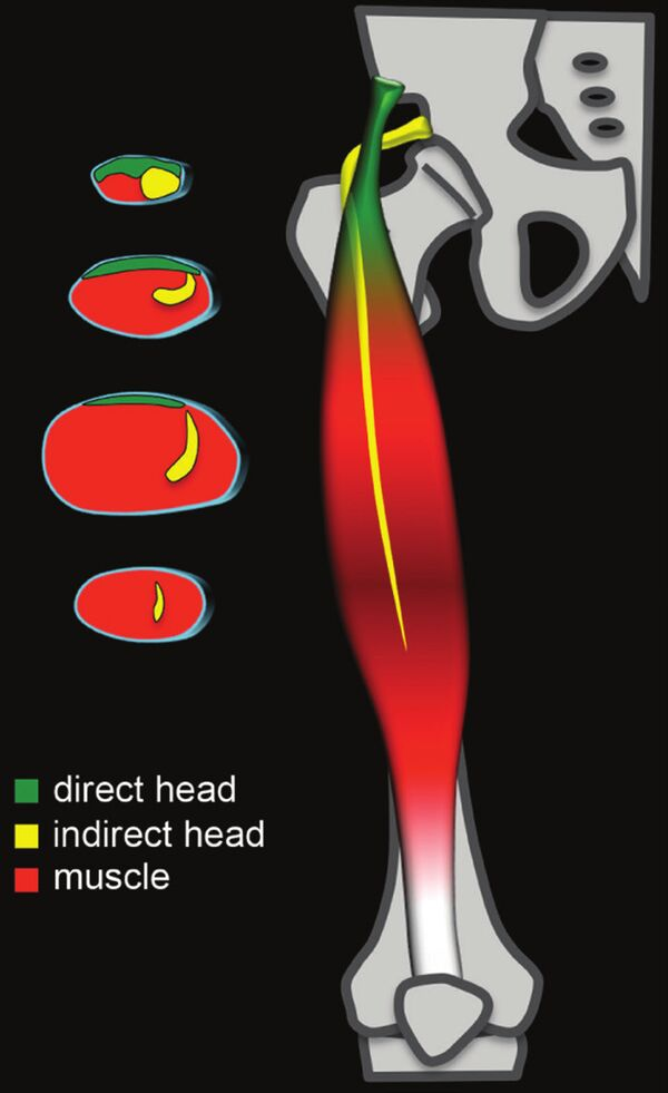 Illustration of rectus femoris muscle anatomy demonstrating the direct head, indirect head, and central intramuscular tendon extending through the muscle belly.