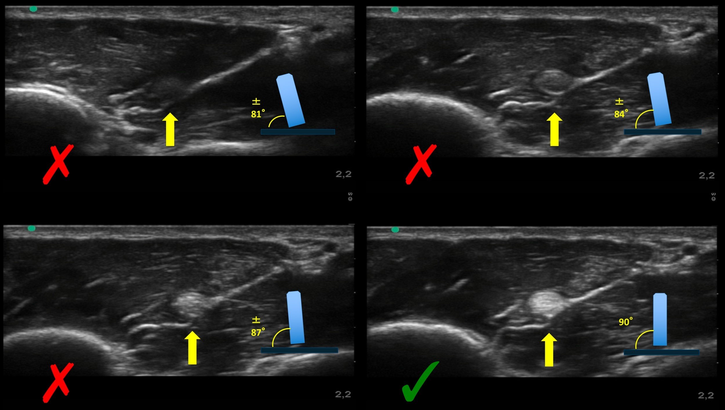 Series of musculoskeletal ultrasound images demonstrating anisotropy caused by incorrect probe angle and improved fiber visualization when the probe is aligned perpendicular to tissue fibers.