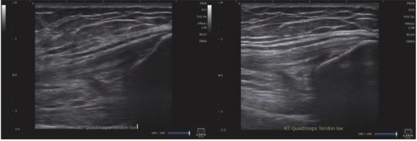 Paired quadriceps tendon ultrasound images showing hypoechoic anisotropy before angle correction and restored fibrillar echogenicity afterward.