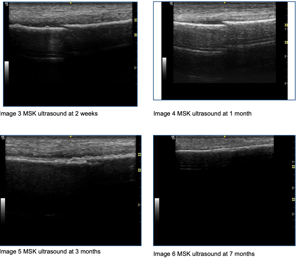 Serial long-axis musculoskeletal ultrasound images of a distal fibular fracture obtained at 2 weeks, 1 month, 3 months, and 7 months following injury. Images demonstrate progressive fracture healing, including reduction of the fracture gap, development of callus formation, increased cortical continuity, and eventual remodeling of the cortical surface.