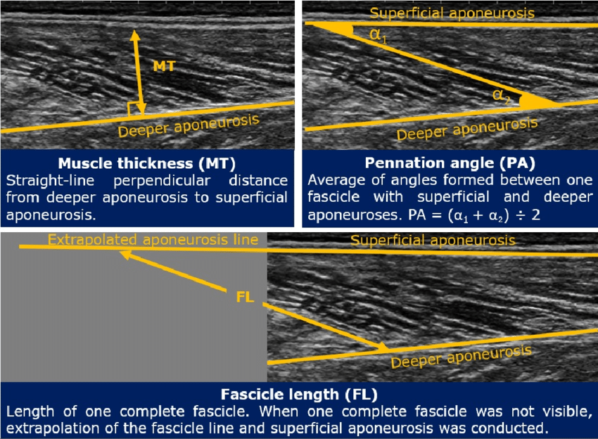 Annotated long-axis ultrasound images demonstrating standard muscle architecture measurements, including muscle thickness measured between superficial and deep aponeuroses, pennation angle calculated from fascicle orientation relative to the aponeuroses, and fascicle length estimated by extrapolating the fascicle line to the superficial aponeurosis when the full fascicle is not visible.