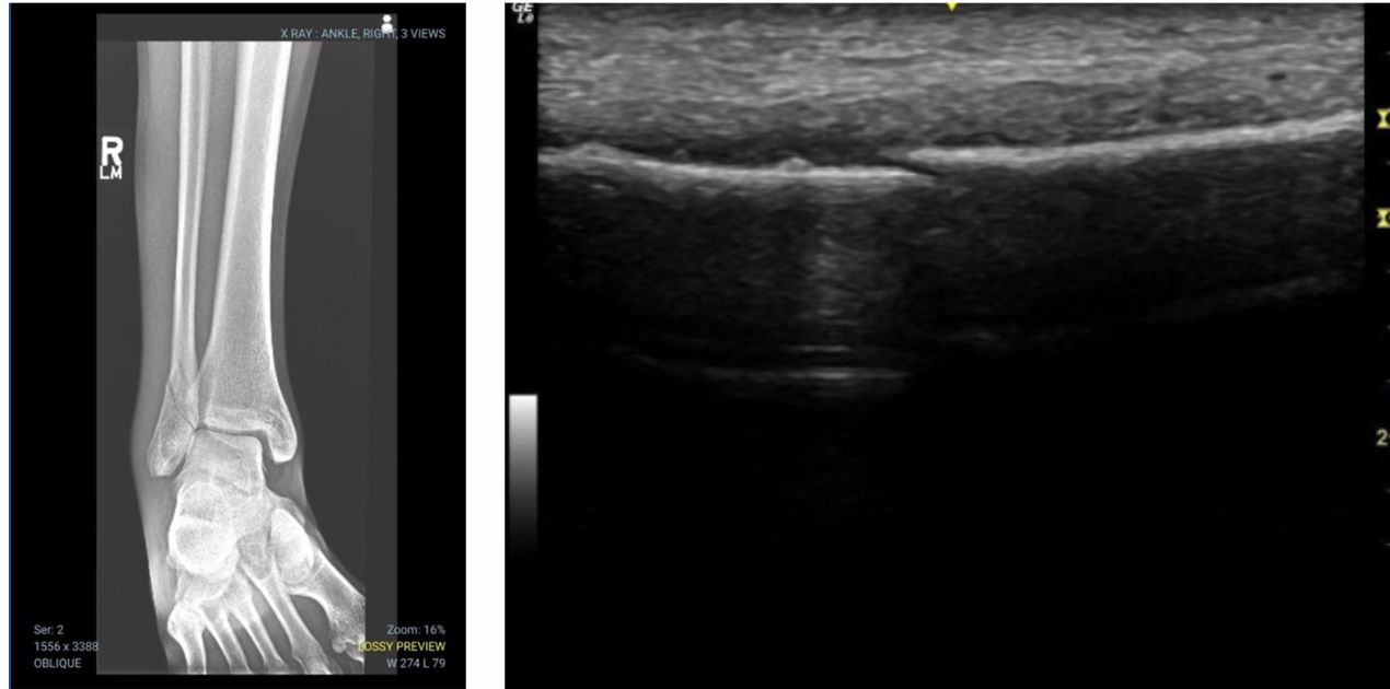 Oblique ankle radiograph demonstrating a distal fibular fracture alongside a long-axis musculoskeletal ultrasound image showing cortical disruption and early fracture healing changes.