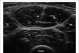 Transverse musculoskeletal ultrasound image of the anterior thigh showing rectus femoris, vastus lateralis, vastus medialis, and underlying femur, highlighting muscle architecture and anatomical relationships.