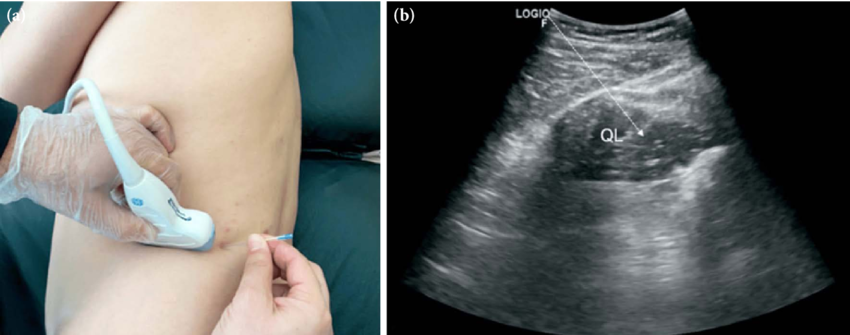 Clinician performing ultrasound-guided dry needling of the quadratus lumborum with corresponding ultrasound image identifying the QL muscle.
