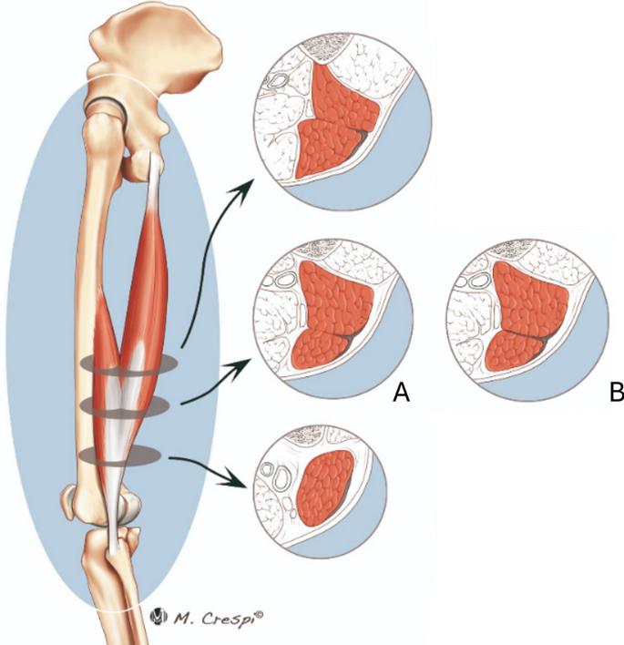 Illustrated posterior thigh anatomy demonstrating the biceps femoris muscle along its length, with corresponding axial cross-sectional views showing variation in muscle morphology and connective-tissue arrangement from proximal to distal regions. This highlights the structural complexity of the distal biceps femoris, including the region where the long and short heads converge.