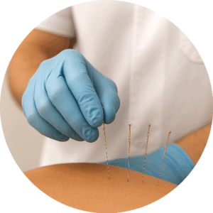 acupuncture