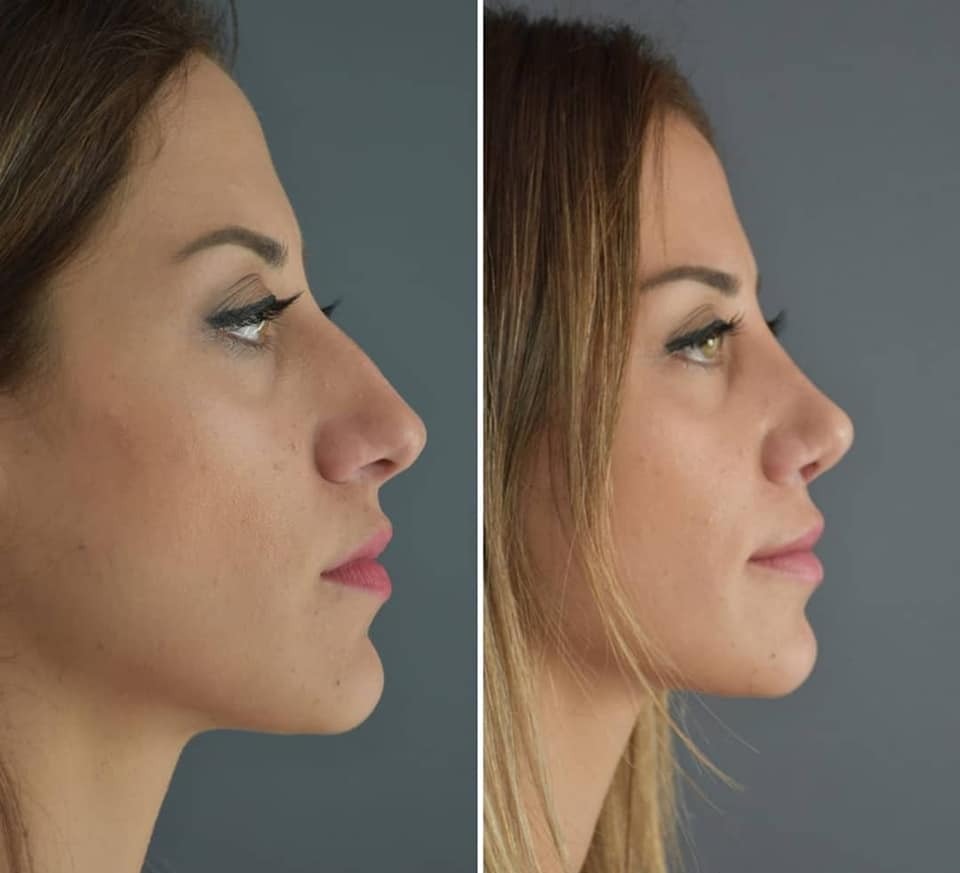Comparação pré e pós-rinosseptoplastia: resultados visíveis