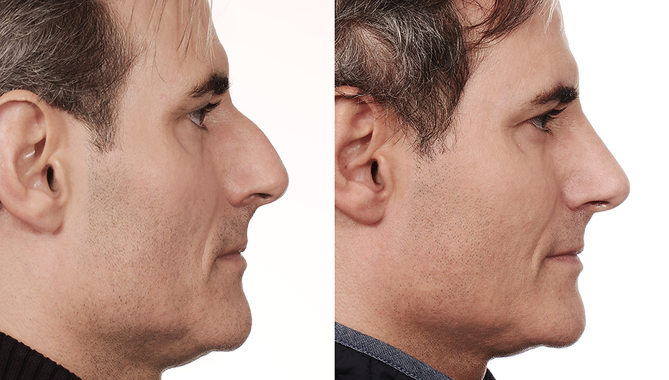 Imagem comparativa mostrando o perfil esquerdo de um nariz grande com giba nasal antes (esquerda) e depois (direita) da rinoplastia em um homem, evidenciando a redução do tamanho, a remoção da giba e a melhora na forma geral