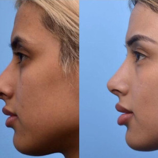 Imagem comparativa mostrando o perfil direito de um nariz de batata antes (esquerda) e depois (direita) da rinoplastia, destacando a melhora na projeção frontal e a redução na largura.