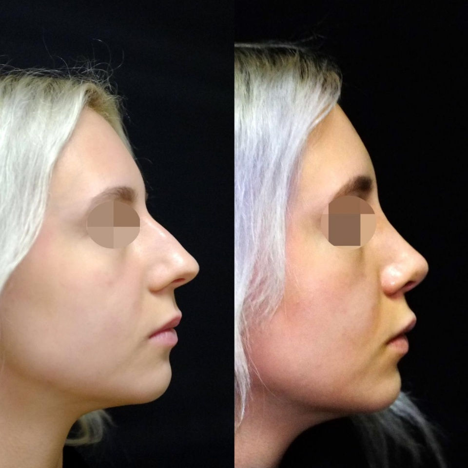 Rinosseptoplastia revelada: sequência de fotos antes e depois