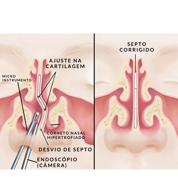 Preço da Septoplastia e Turbinectomia em 2025