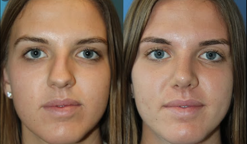 Rinosseptoplastia em foco: imagens comparativas antes e após