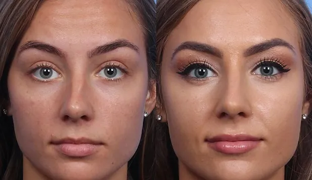 Impacto visual da rinosseptoplastia: comparação antes e depois