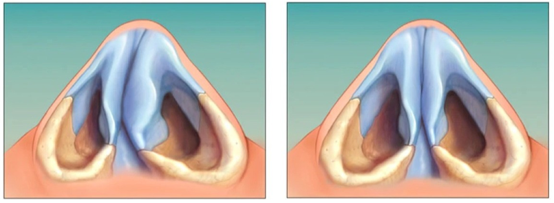 Comparação das Narinas com e sem Desvio de Septo