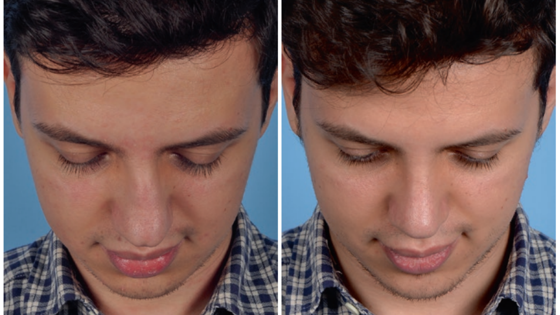 Imagem comparativa mostrando a vista frontal de um nariz torto antes (esquerda) e depois (direita) da rinoplastia, ressaltando a aparência geral mais harmoniosa e a melhora na simetria.