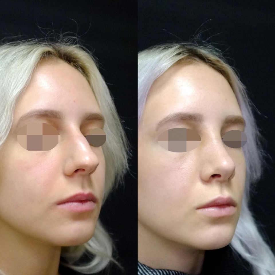 Contraste pré e pós-operatório: efeitos da rinosseptoplastia