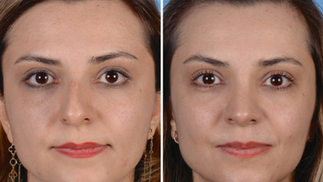 Antes e depois septoplastia mulher