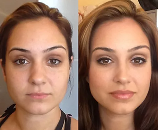 Imagem comparativa mostrando a vista frontal de um nariz de batata antes (esquerda) e depois (direita) da rinoplastia, ressaltando a ponta mais fina e a aparência geral mais harmoniosa.