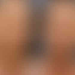 Imagem comparativa mostrando a vista frontal de um nariz grande com giba nasal antes (esquerda) e depois (direita) da rinoplastia, ressaltando a aparência geral mais harmoniosa, a melhora na simetria e a redução no tamanho.