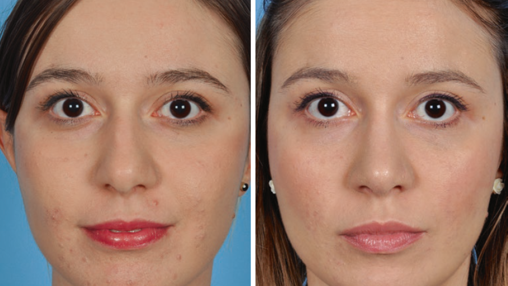 Imagem comparativa mostrando a vista frontal de um nariz de batata antes (esquerda) e depois (direita) da rinoplastia, ressaltando a ponta mais fina e a aparência geral mais harmoniosa.
