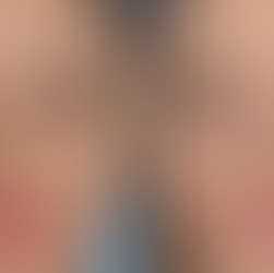 Imagem comparativa mostrando a vista frontal de um nariz de batata antes (esquerda) e depois (direita) da rinoplastia, ressaltando a ponta mais fina e a aparência geral mais harmoniosa.