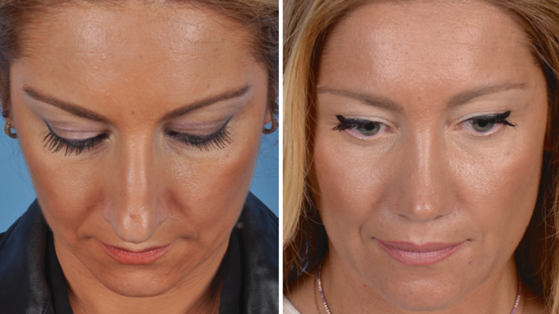 Imagem comparativa mostrando a vista frontal de um nariz de batata antes (esquerda) e depois (direita) da rinoplastia, ressaltando a ponta mais fina e a aparência geral mais harmoniosa.