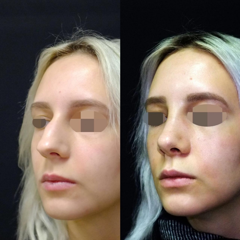 Documentação fotográfica: pré e pós-rinosseptoplastia
