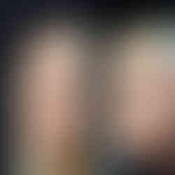 Documentação fotográfica: pré e pós-rinosseptoplastia