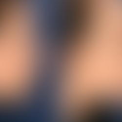 Imagem comparativa mostrando o perfil esquerdo de um nariz com giba nasal antes (esquerda) e depois (direita) da rinoplastia, evidenciando a remoção da giba e a melhora na linha do nariz.