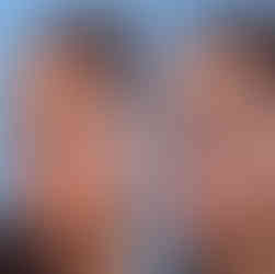 "Imagem comparativa mostrando a vista frontal de um nariz grande com giba nasal antes (esquerda) e depois (direita) da rinoplastia, ressaltando a aparência geral mais harmoniosa, a melhora na simetria e a redução no tamanho.