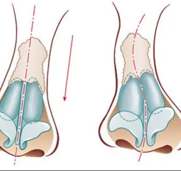 Septo Nasal Sinuoso: O Que É, Sintomas e Tratamentos