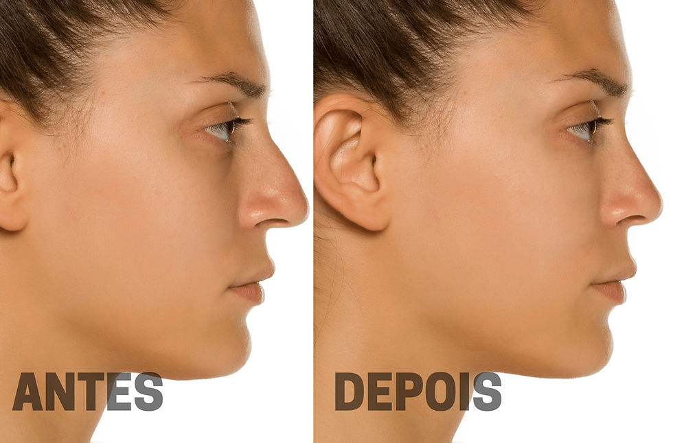 Antes e Depois: Histórias Reais de Sucesso da Rinoplastia em Nariz Grande