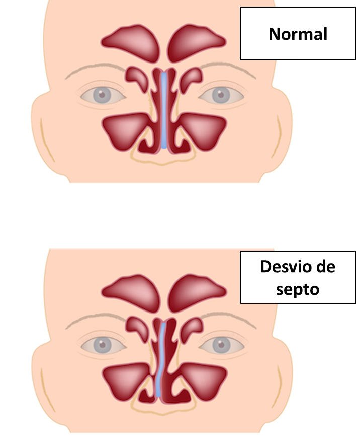 desvio de septo