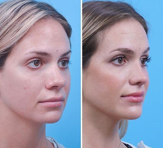 Imagem comparativa mostrando a vista frontal de um nariz com giba nasal antes (esquerda) e depois (direita) da rinoplastia, ressaltando a aparência geral mais harmoniosa e a melhora na simetria.