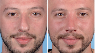 Antes e depois septoplastia homem
