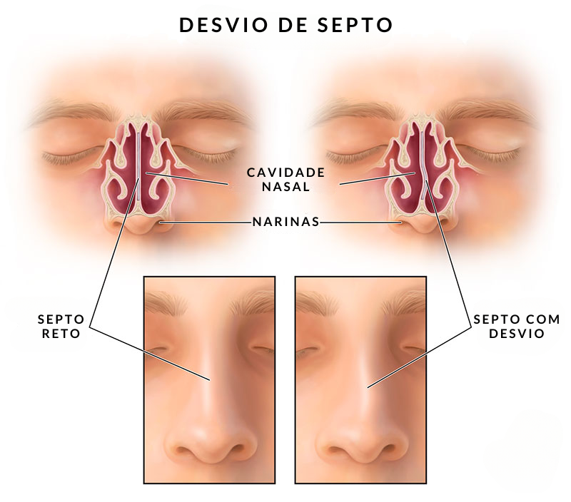 Desvio de Septo Grau 3: Causas, Sintomas e Tratamentos