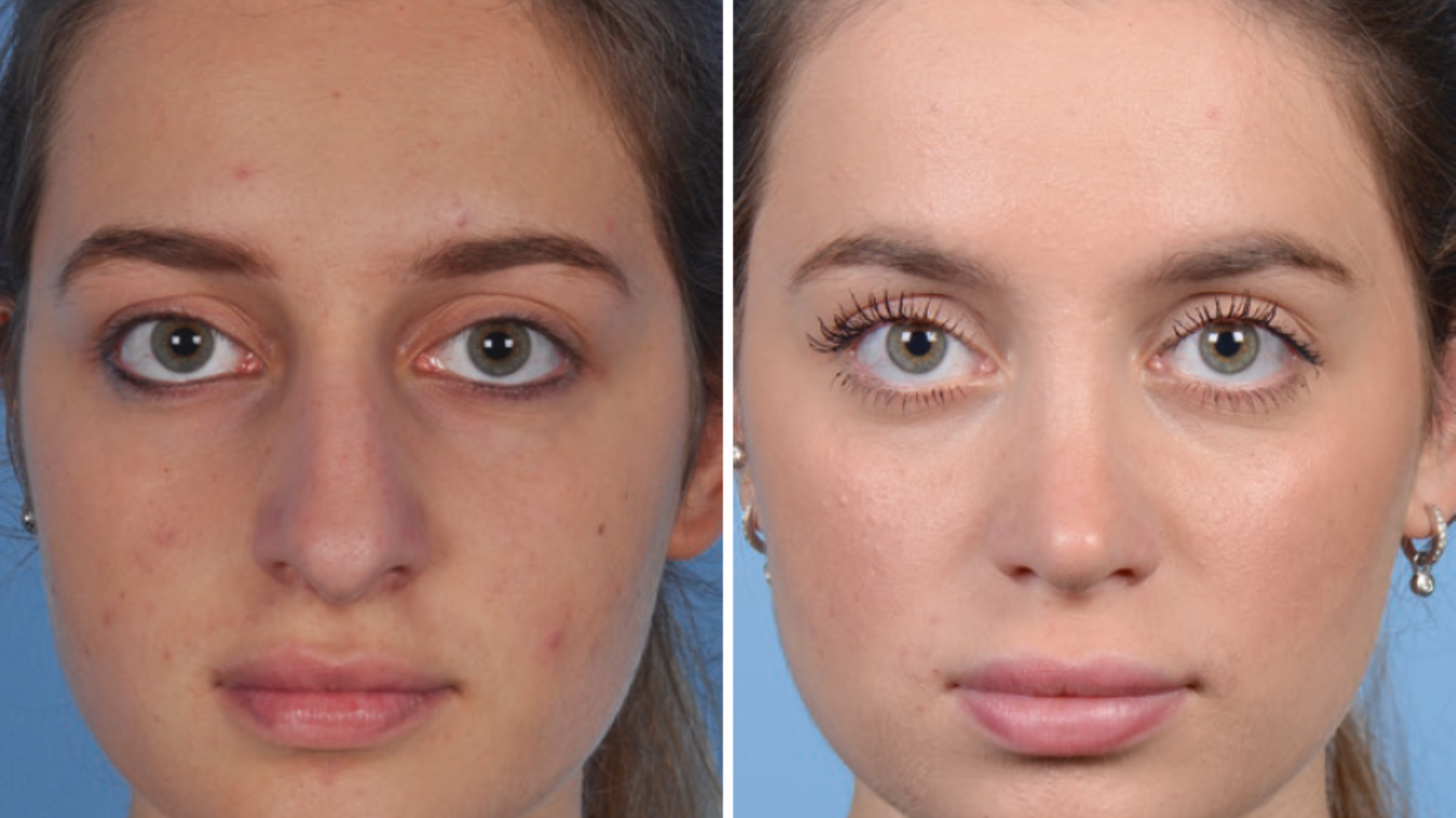 Imagem comparativa mostrando a vista frontal de um nariz torto antes (esquerda) e depois (direita) da rinoplastia, ressaltando a aparência geral mais harmoniosa e a melhora na simetria.