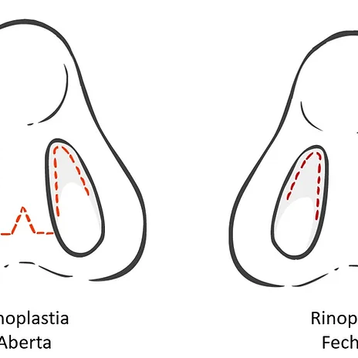 Rinoplastia Fechada