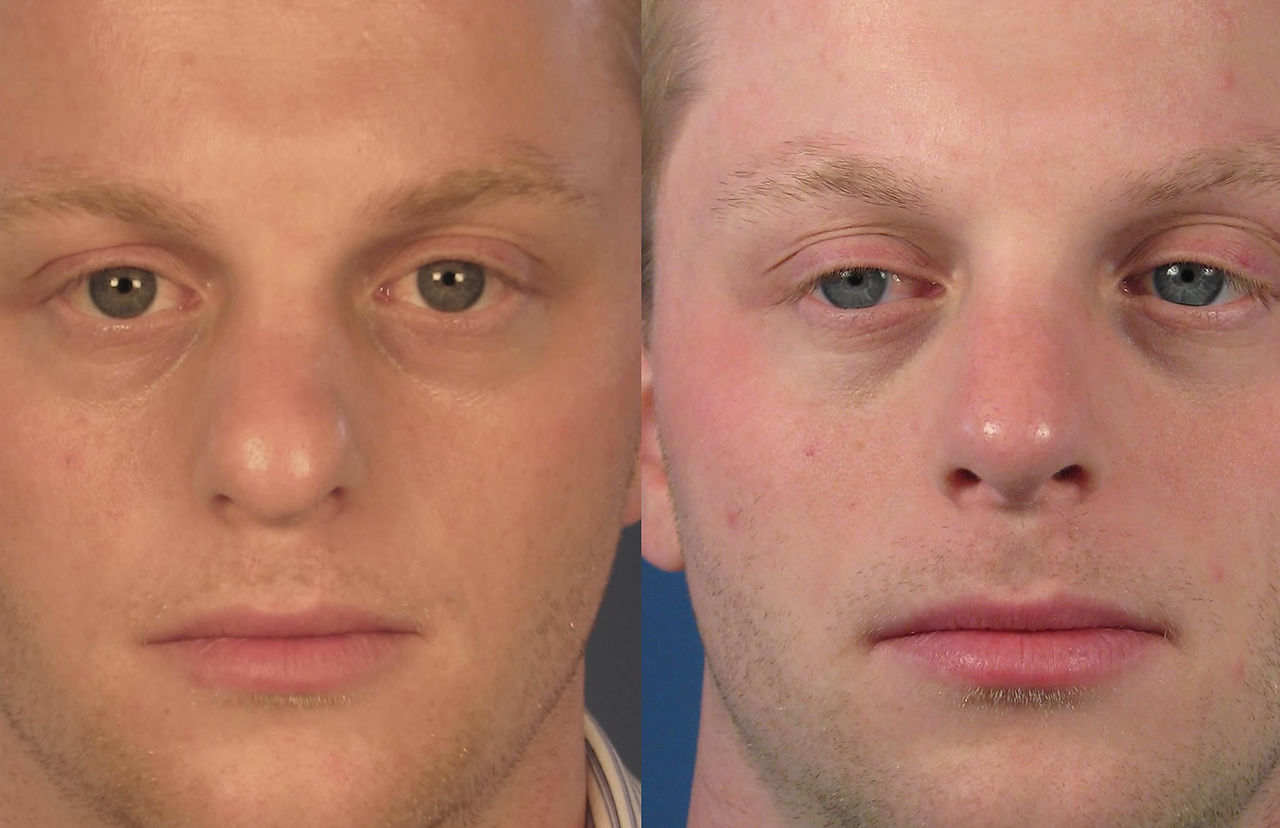 Imagem comparativa mostrando a vista frontal de um nariz de batata antes (esquerda) e depois (direita) da rinoplastia em homem, ressaltando a ponta mais fina e a aparência geral mais harmoniosa.
