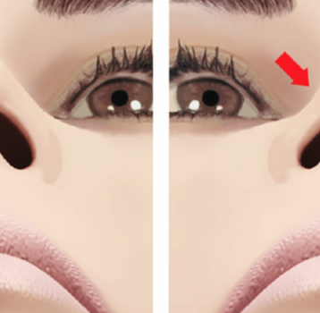 Válvula nasal: Anatomia, alterações, colapso, insuficiência e cirurgia