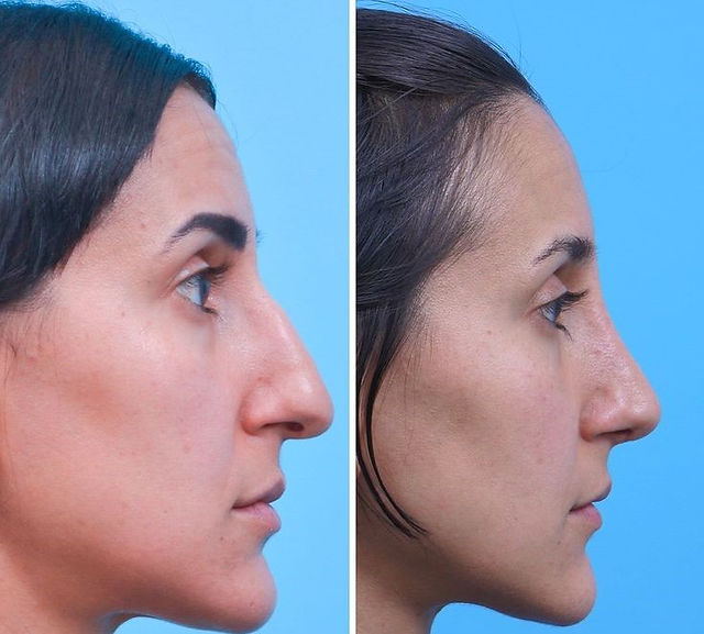 Imagem comparativa mostrando o perfil esquerdo de um nariz com ponta caída e giba nasal antes (esquerda) e depois (direita) da rinoplastia, evidenciando a elevação da ponta e a melhora na forma geral.