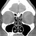 tomografia cornetos nasais normais